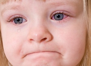 Trẻ bị đau mắt trắng 