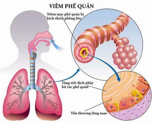 Trẻ bị viêm phế quản, viêm họng có thể dẫn đến ung thư phổi