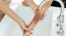 Cẩn thận với những trường hợp khiến cho trẻ bị sẹo