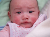 Trẻ bị chàm sữa và những điều mẹ tuyệt đối không được bỏ qua