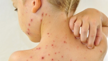 Trẻ bị phỏng dạ có thể dẫn đến viêm não, thậm chí tử vong