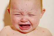 Trẻ bị sởi dẫn đến đau bụng là triệu chứng vô cùng nguy hiểm